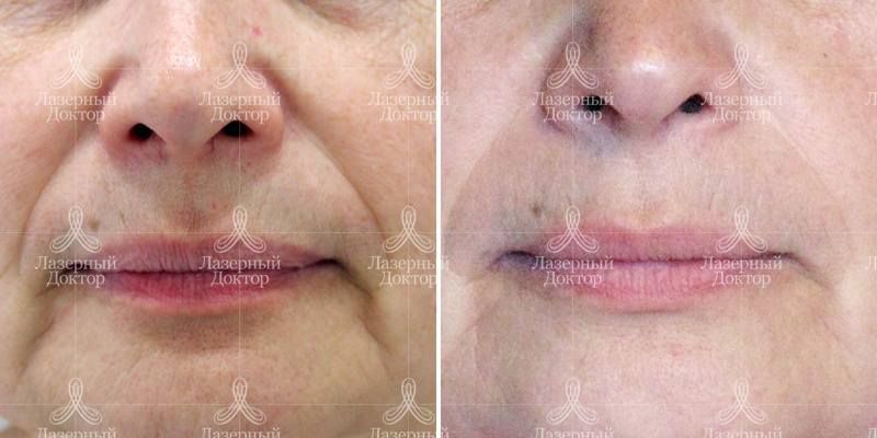 Игольчатый лифтинг infini 3d