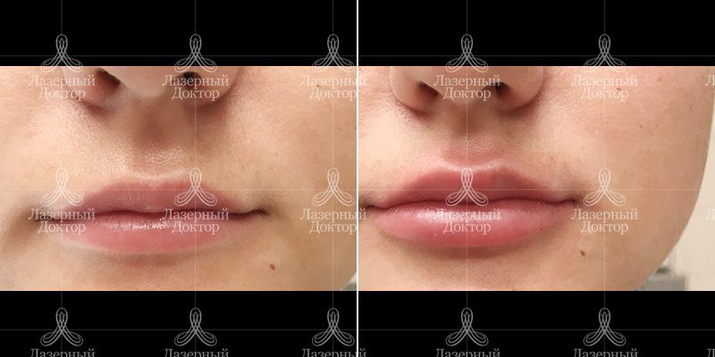 контурная пластика губ