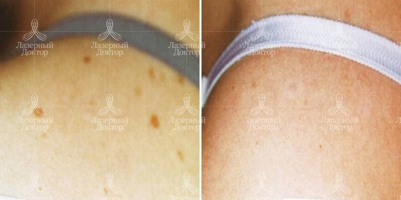 Фототерапия области плеч