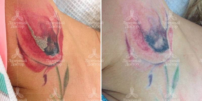 Лазерное удаление татуировки на теле