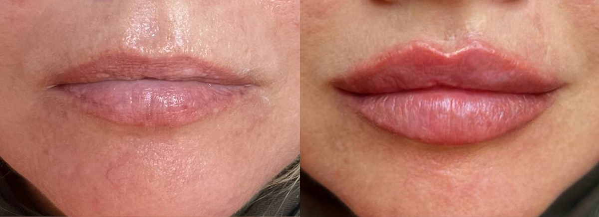 Контурная пластика губ 