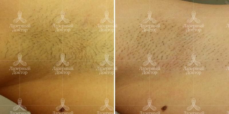 Подмышки после эпиляции александритовым лазером (результат)