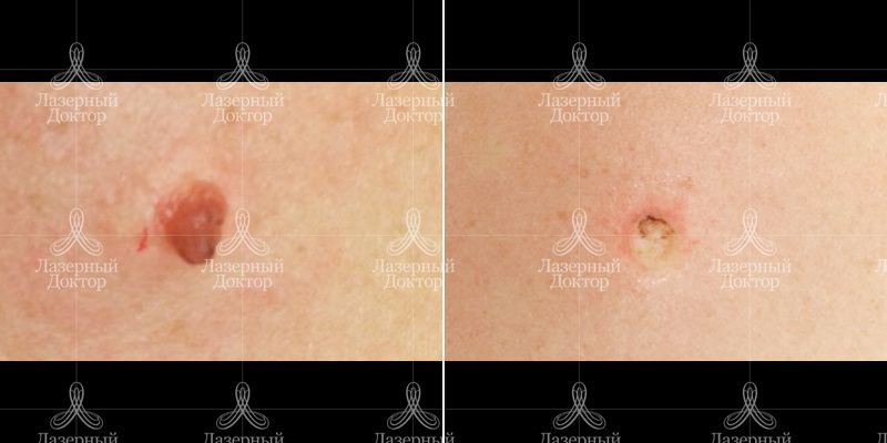 новообразования до и после