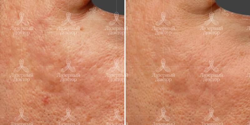 3д волюмизация (аппарат инфини)