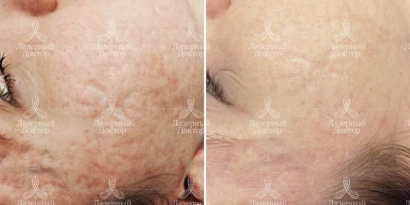 Лазерное удаление шрамов на лице