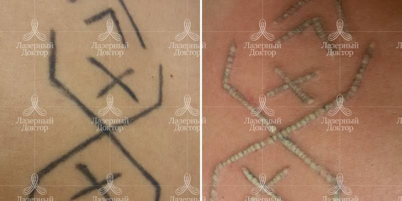 Лазерное удаление татуировки на теле