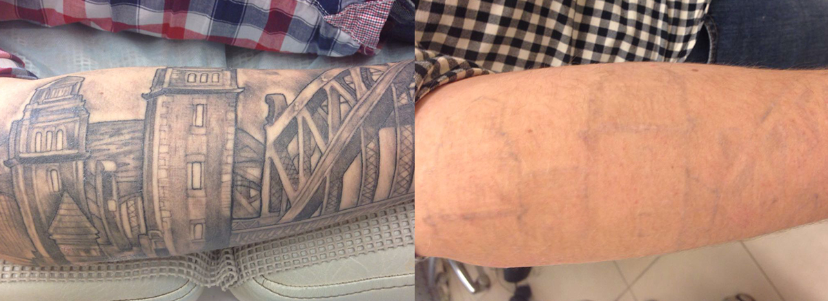 Удаление татуировок 