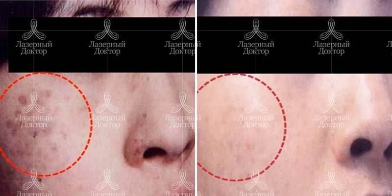 Удаление пигментных пятен на щеках