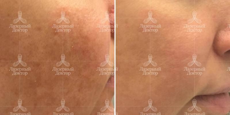 Лазерная процедура ДОТ