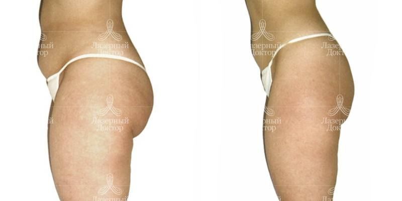 Массаж lpg: до и после