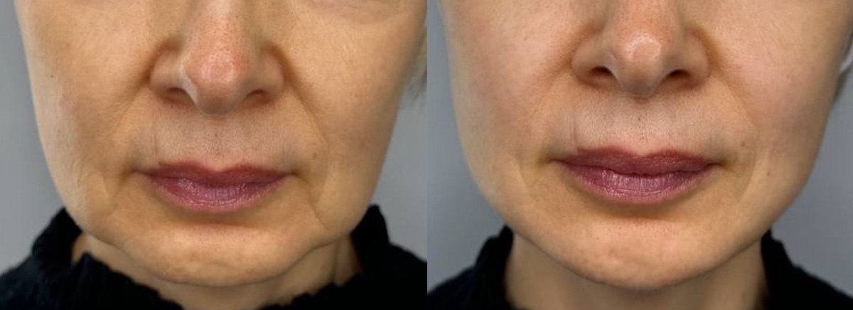 Лифтинг мезонитями