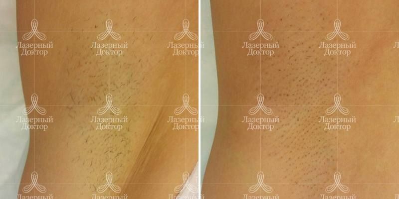 Подмышки после лазерной эпиляции (фото)