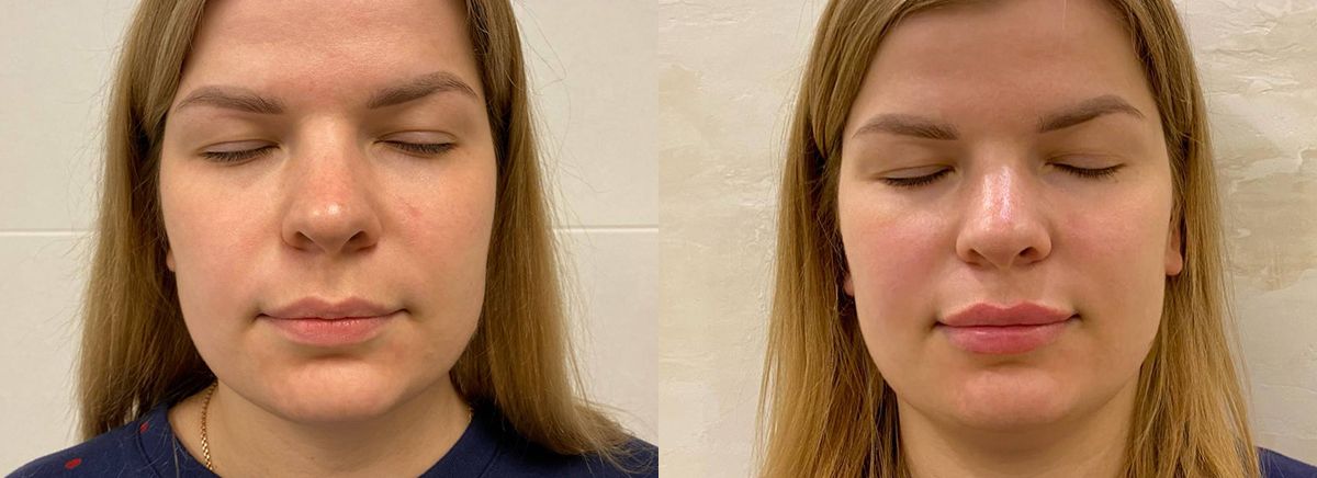 Биоревитализация лица