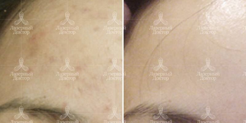 Лечение акне в Санкт-Петербурге