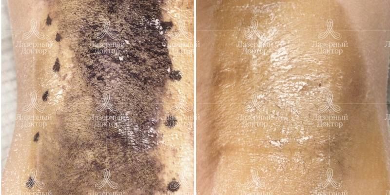 Гипергидроз подмышек: лечение