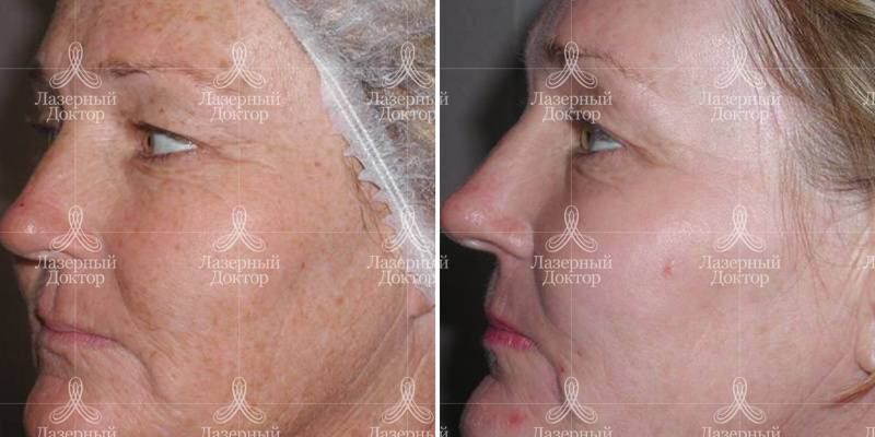 Лазер Фраксель