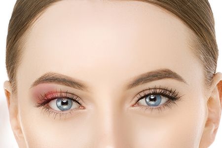 Халязион: причины, симптомы, лечение, методы удаления