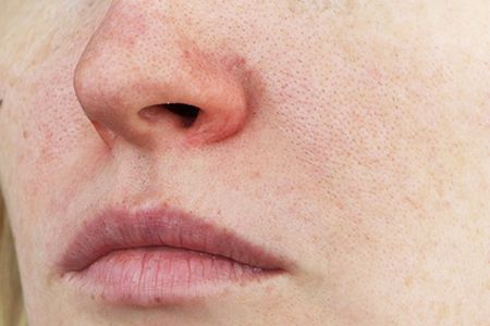 Купероз и розацеа: в чем разница и как лечить