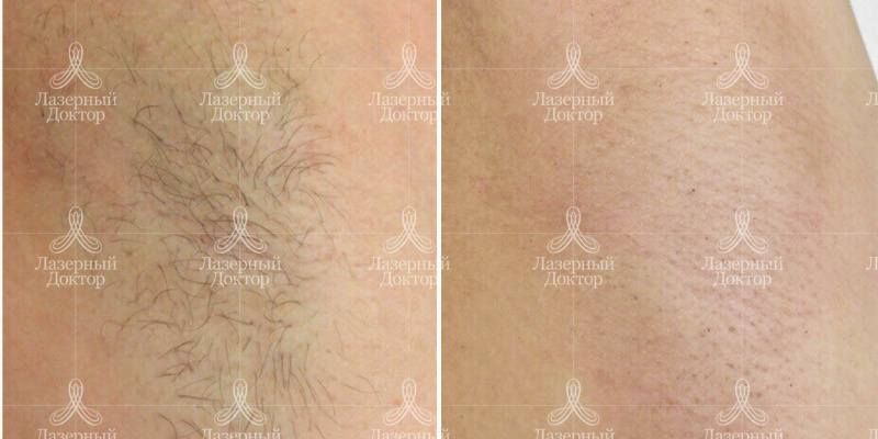 Подмышки после лазерной эпиляции (фото)