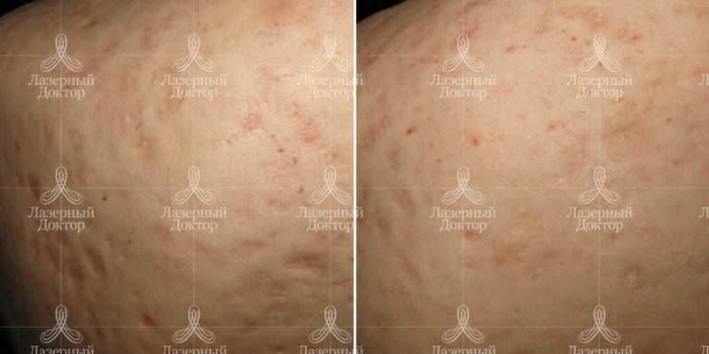 Пилинг всего тела