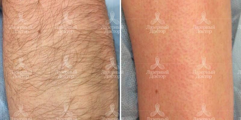 Результат лазерной эпиляции для рук (фото до и после)