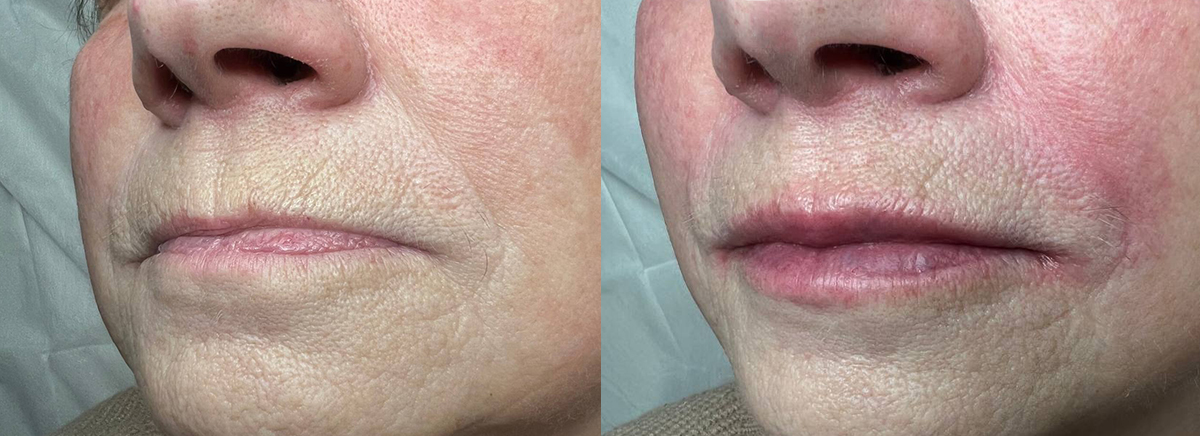 Контурная пластика губ 