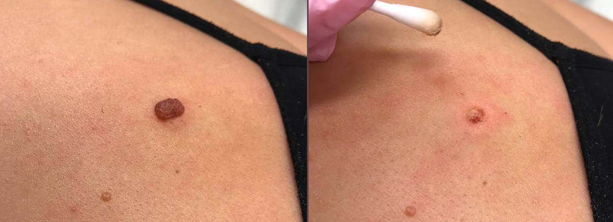 удаление новообразования