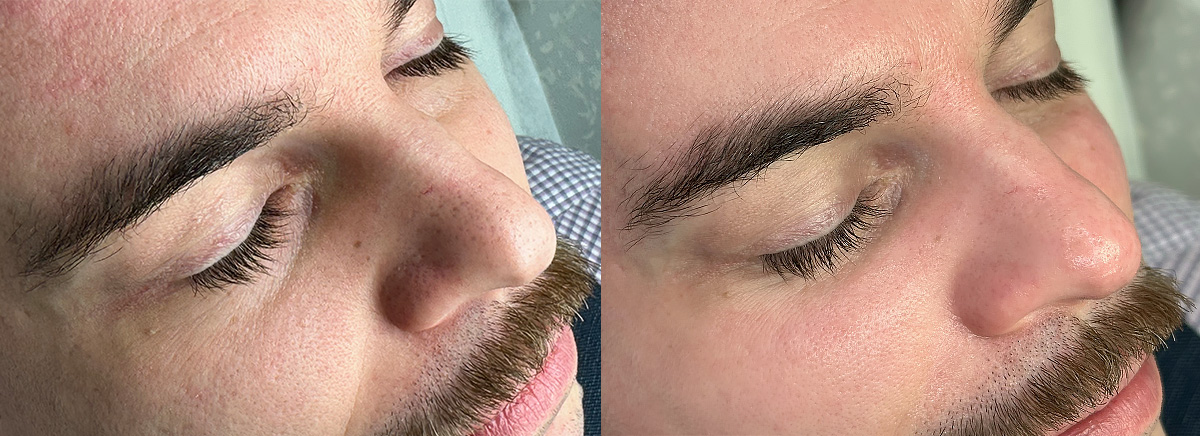 Вакуумный гидропилинг HydraFacial