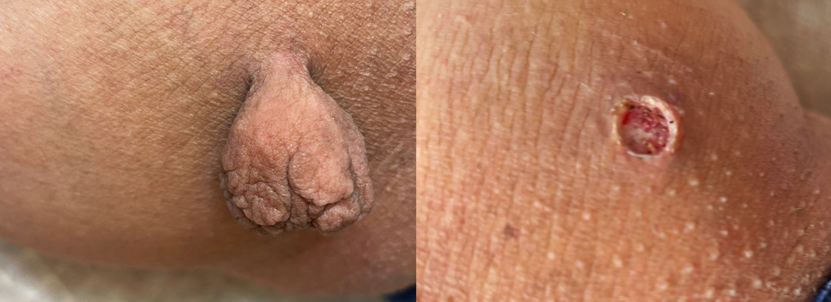 Удаление папилломы