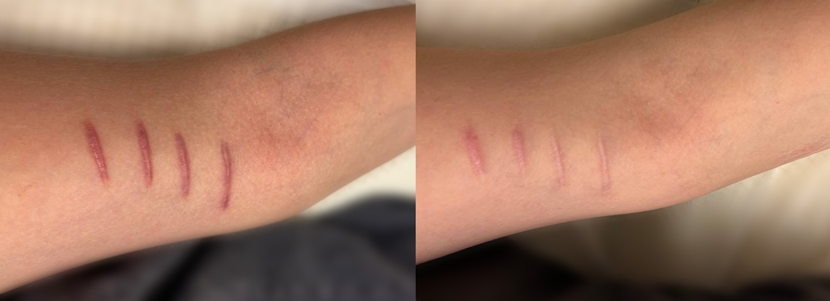 Удаление шрамов на теле