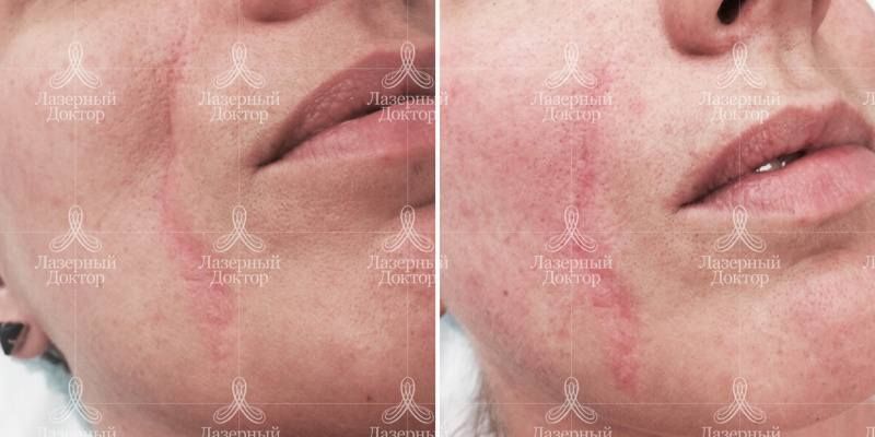 Объемная пластика средней трети лица