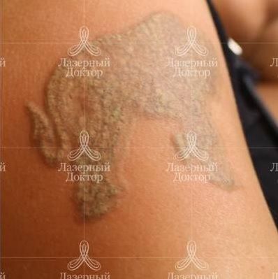 Лазерное удаление татуировки на предплечье после