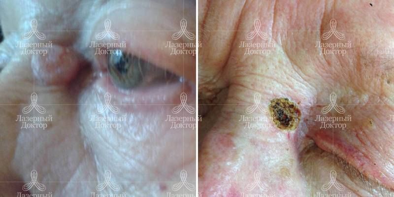 Лазерное удаление новообразования на лице