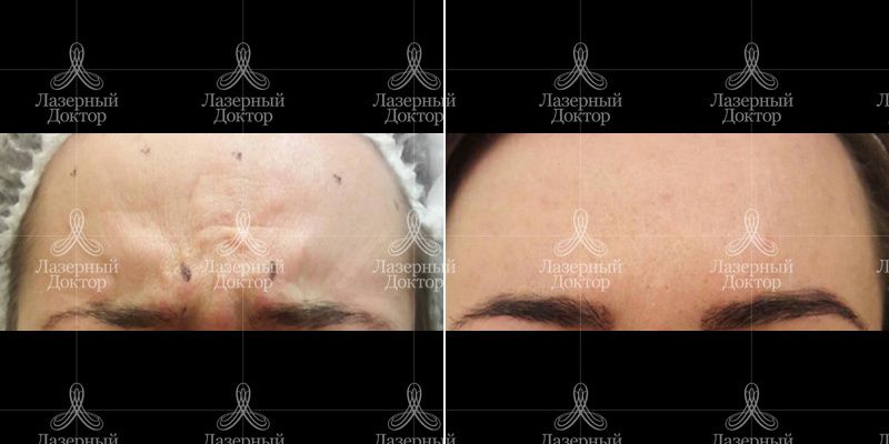 мимические морщины лоб