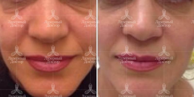 Подтяжка лица мезонитями (фото)