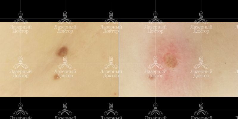 новообразования до и после