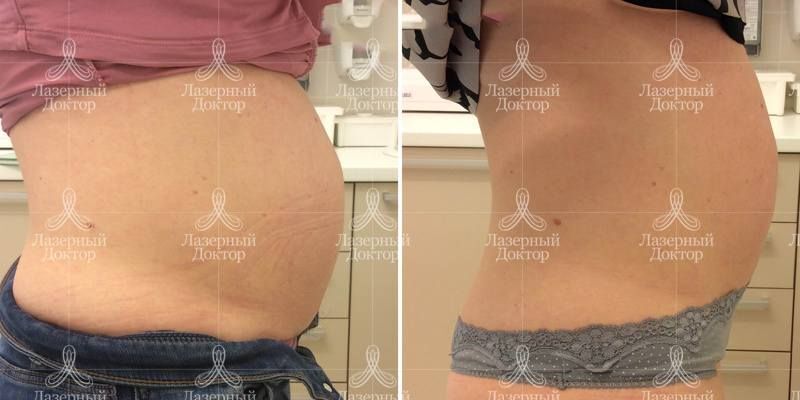 Интралипотерапия препаратом aqualyx (фото до и после)