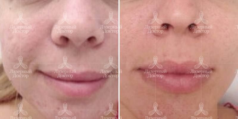 Фракционное лазерное омоложение ДОТ