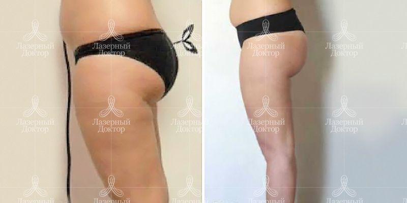 эндосфера терапия до и после