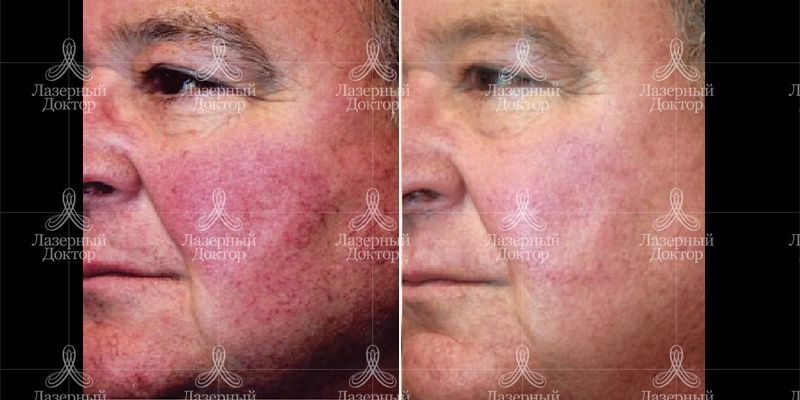 BBL До и После лицо