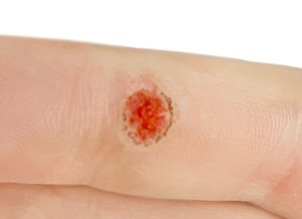 Удаление новообразований фото до и после