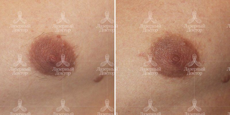 Лазерная эпиляция Мовео Дека (фото до и после)