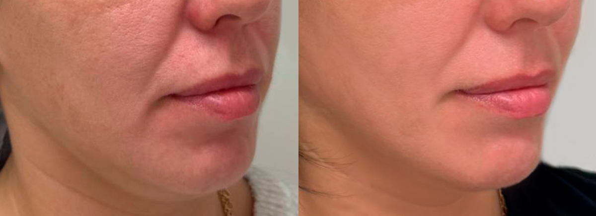 SMAS-лифтинг Ultraformer lll 