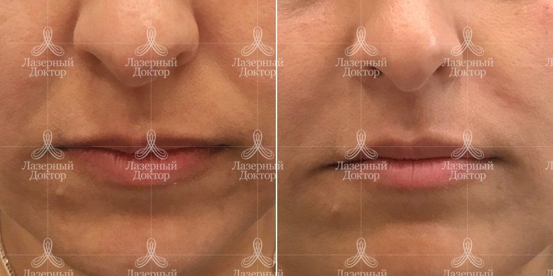 Контурная пластика носогубных складок