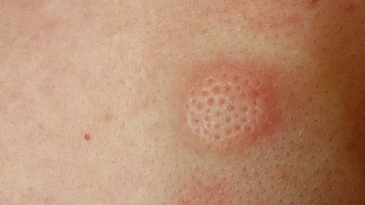 Атерома: причины, симптомы, лечение, методы удаления