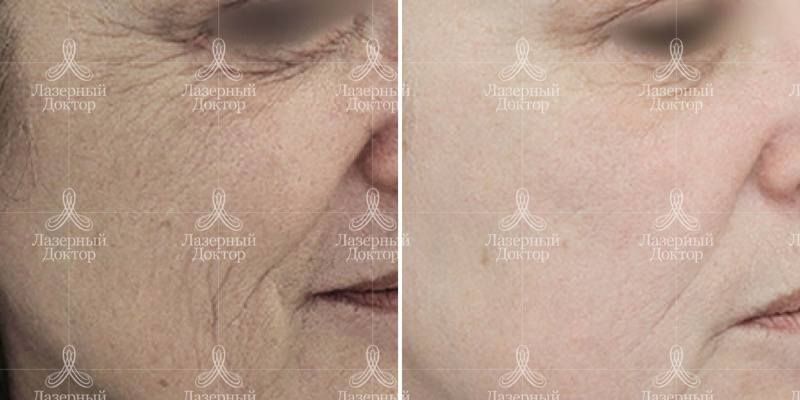 омоложение infini