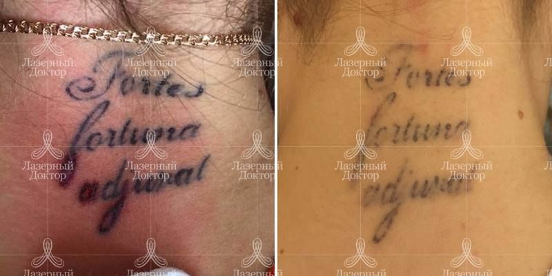 Лазерное удаление татуировки на шее