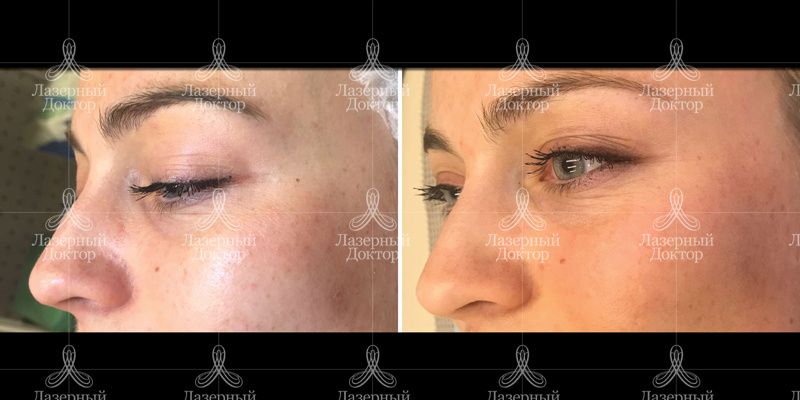ДОТ-омоложение: фото до и после