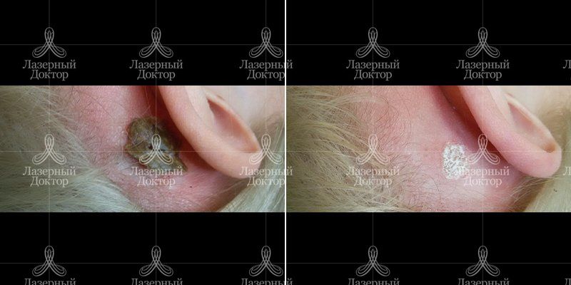 Удаление новообразования