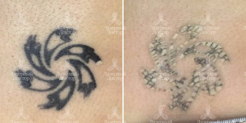 Лазерное удаление татуировки на спине